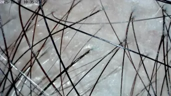 女性雄性禿頭皮皮膚鏡影像