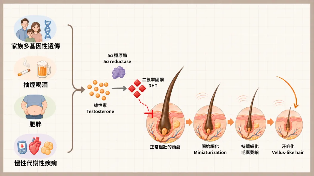 毛囊微小化示意圖:睪固酮經 5α-reductase 轉化為 DHT 後造成毛囊逐漸萎縮