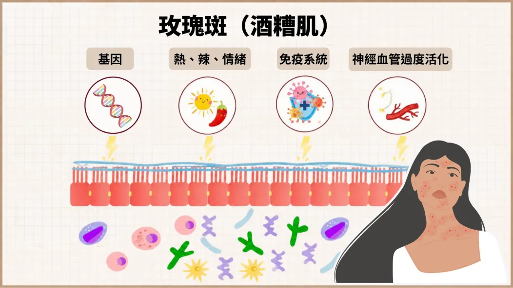 玫瑰斑致病機轉示意圖:基因、熱辣情緒、免疫系統與神經血管過度活化共同作用於皮膚