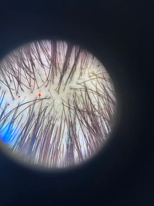 皮膚鏡下的短再生毛，星號處為新生的短毛
