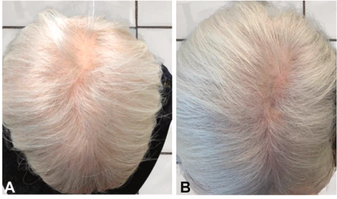 Finasteride + Minoxidil 治療前後對比