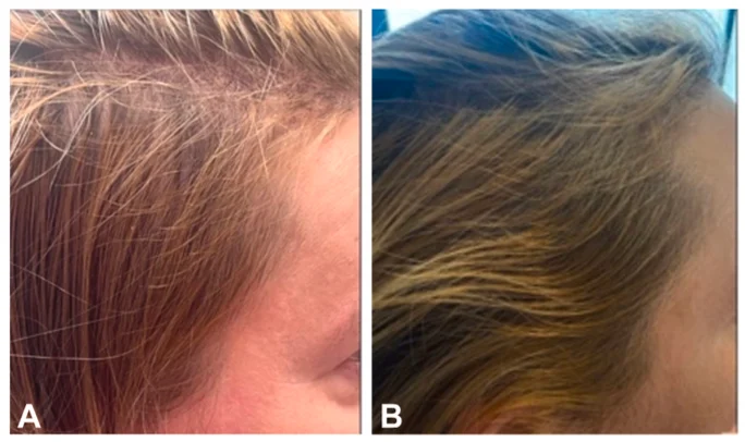 口服 Minoxidil 治療前後對比