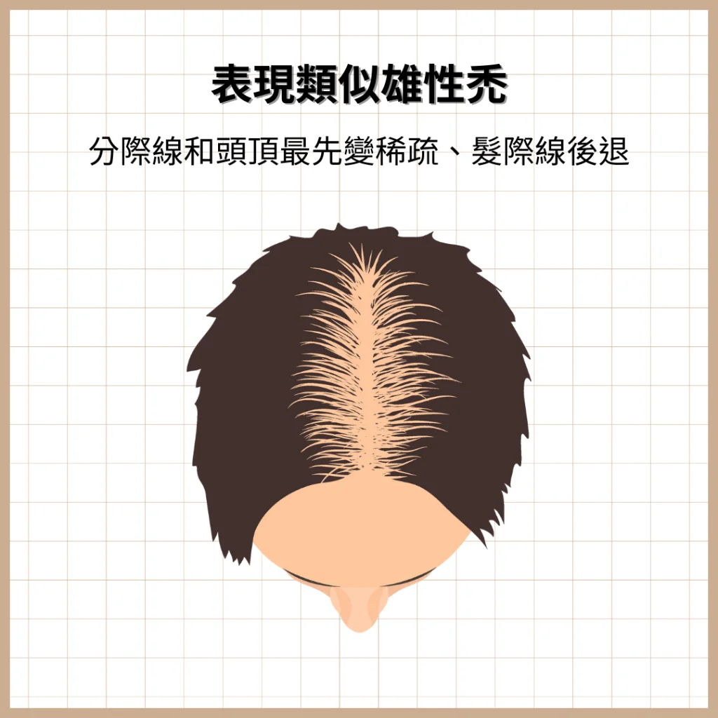 表現類似雄性禿：分際線和頭頂最先變稀疏、髮際線後退